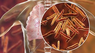 What is Tuberculosis TB and its types Symptoms Treatment [upl. by Ehr]