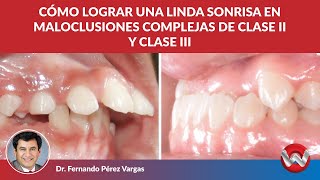 Cómo lograr una linda sonrisa en maloclusiones complejas de clase II y clase III [upl. by Boice993]