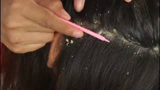 Dandruff scratching removal on head using black combing08 [upl. by Murrah]