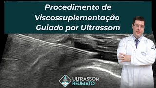 Procedimento de Viscossuplementação Guiado por Ultrassonografia em Osteoartrite de Joelho [upl. by Rases]