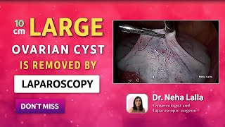 2022 Ovarian Cyst Signs and Symptoms  Scarless Laparoscopic Treatment  Dr Neha Lalla [upl. by Atsylak605]