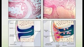 Rheumatoid Arthritis and Systemic Lupus Erythematosus Webinar [upl. by Abba]