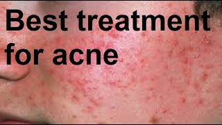 Best treatment for acne [upl. by Ahsienat346]