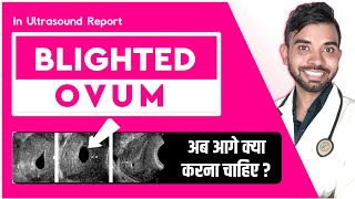 Blighted ovum pregnancy in hindi  blighted ovum in ultrasound  blighted ovum causes amp treatment [upl. by Eeltrebor]