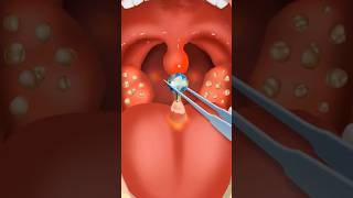 ASMR mouth care remove tongue piercing pus amp tonsil stones mouth clean 2d animation video [upl. by Timmons]