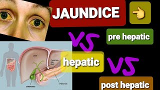 JAUNDICE  PRE HEPATIC VS POST HEPATIC JAUNDICE  DR SHAHRUKH [upl. by Emia]