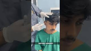 Bat Ear Correction under Local Anesthesia  Otoplasty in India  Before Surgery shorts [upl. by Annabel594]