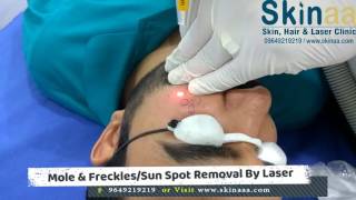 Sun Spots Removal Treatment by Nd Yag QSwitched Laser [upl. by Shaefer214]