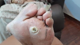 Warts Remove treatment part 2Treatment Continuefootcallous satisfying footcomfort footcare foot [upl. by Decca]