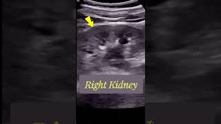 Tracing the Large  Obstructed Ureteric stone  Ultrasound [upl. by Walter]