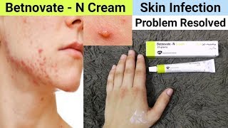 Betnovate N Cream Review  Benefits amp Uses  Betnovate N Cream for Face Acne Pimples [upl. by Milka]