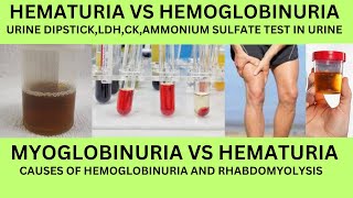 HOW TO DIFFERNTIATE HEMATURIA VS HEMOGLOBINURIA VS MYOGLOBINURIACAUSES URINE DIPSTICKLDH AND CK [upl. by Notnroht400]