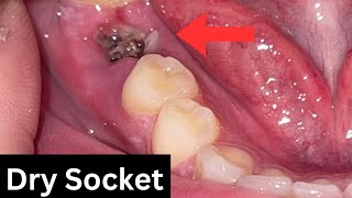 Pain After Tooth Extraction Wisdom Tooth Extraction  Dry Socket Explained [upl. by Doscher]