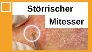 Störrischer Mitesser entfernt Dr Kasten Hautmedizin in Mainz [upl. by Anillehs]