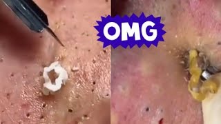 Top Acne Scar Treatments Proven Methods to Clear Your Skin Fast [upl. by Entruoc]