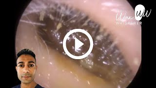 999  Fully Occluding Blocked Ear Wax Removal [upl. by Nohs]