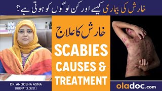 KHARISH KA ILAJ  Scabies Treatment In Urdu  Kharish Ki Bimari Kyun Hoti Hai  Itching Solution [upl. by Fulks948]