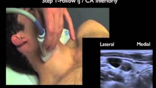 How to Supraclavicular Approach to Subclavian Vein Cannulation [upl. by Aicnatsnoc]