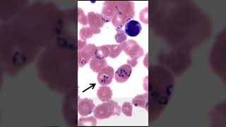 Quiz What are these parasites in red blood cells [upl. by Anirav]