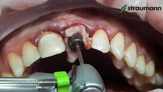 Straumann® BLX Immediate Incisor Placement and Loading Step by step overview [upl. by Anelrad840]