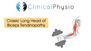 Classic Long Head of Biceps Tendinopathy  Clinical Physio [upl. by Royall]