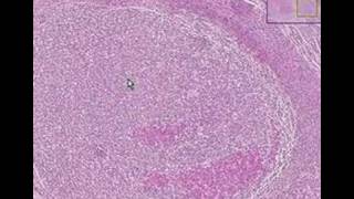 Histopathology ParathyroidTertiary hyperparathyroidism [upl. by Aciretahs]