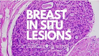 Breast In Situ Lesions Kurt’s Notes pathagonia [upl. by Prem]