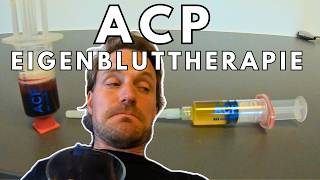 ACP Eigenbluttherapie für die Patellasehne  die erste Sitzung [upl. by Heady]