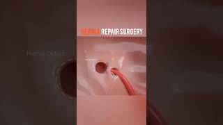 Inguinal Hernia Repair Surgery [upl. by Annahc]