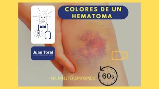 Mi HEMATOMA ha cambiado de color 😱 ¿Tengo que preocuparme  ⏱️💊 𝔼𝕝 𝕄𝕚𝕟𝕦𝕥𝕠 ℂ𝕠𝕞𝕡𝕣𝕚𝕞𝕚𝕕𝕠 36 ⏱️💊 [upl. by Ellennahc954]