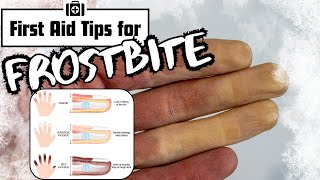 Frostbite  Symptoms and First Aid [upl. by Ael913]