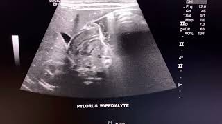 Ultrasound cases POSITIVE Hypertrophic Pyloric Stenosis  pediatric sonography [upl. by Yerffej]