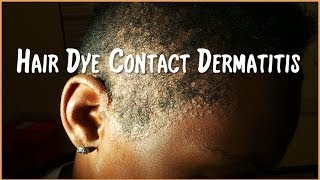 Severe Hair Dye Contact Dermatitis [upl. by Aidnyc]