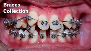 braces process collection [upl. by Drahnreb785]