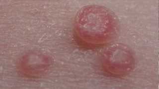 How to treat Molluscum Contagiosum [upl. by Alidia667]