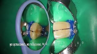 SIMPLE TECHNIQUE FOR CALCIFIED CENTRAL INCISOR MANAGEMENT [upl. by Billi]