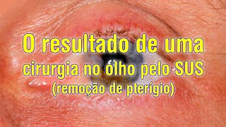 Como é a cirurgia no olho para remoção de pterígio feita pelo SUS [upl. by Eelac493]