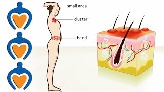 Shingles  The causes symptoms treatment and prevention [upl. by Galer]