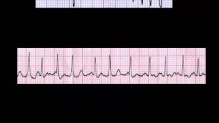 CURSO DE ELECTROCARDIOGRAFIA 24  AUTOEVALUACIÓN SOBRE MEDICIÓN DE FRECUENCIA [upl. by Hgiel202]