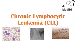 Chronic Lymphocytic Leukemia CLL Symptoms ex Skin Blisters Diagnosis and Treatment Vit D [upl. by Willi370]