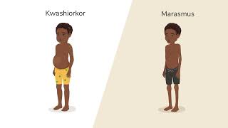 What is Malnutrition [upl. by Ahsrav]