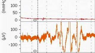 Bupivacaine Cardiotoxicity in an Anesthetized Rat [upl. by Ahsilad]