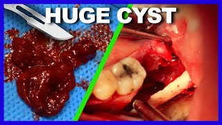 Extracted CYST HUGE [upl. by Yxel]