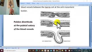 Intestinal Disorders in Arabic 8  Diverticular Disease of Colon  by Dr Wahdan [upl. by Delphine]