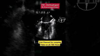 Mitral Comissural View on Transesophageal Echocardiogram echocardiography heart [upl. by Eittocs485]