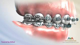 Orthodontics Treatment for Overjet Overbite  Headgear vs Forsus Appliance [upl. by Kelcy]