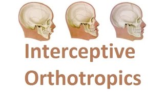 Correcting the Growth of Upper Jaw with Interceptive Orthotropics by Prof John Mew [upl. by Ylrad]