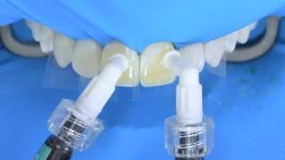 Fluorosis treatment using Icon infiltration step by step [upl. by Truda]