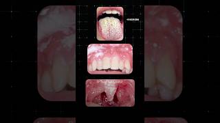 வாயில் ஏற்படும் பூஞ்சை தொற்று Oral Thrush Dr Isacc Abbas [upl. by Yadnus448]