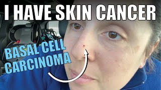 I HAVE SKIN CANCER  Basal Cell Carcinoma  signs what it looks like biopsy treatment plan [upl. by Ojimmas388]